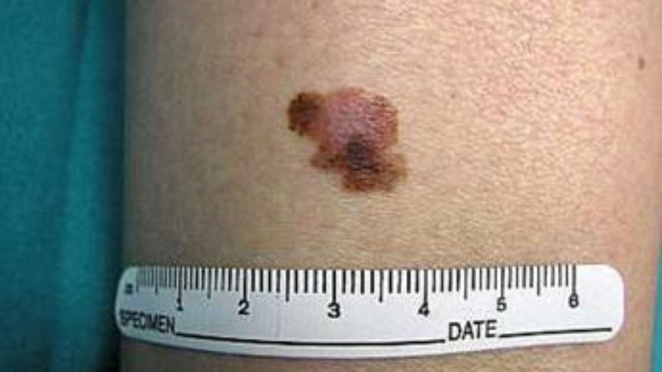 Tumori, contro melanoma il virus dell'herpes modificato funziona: lo studio