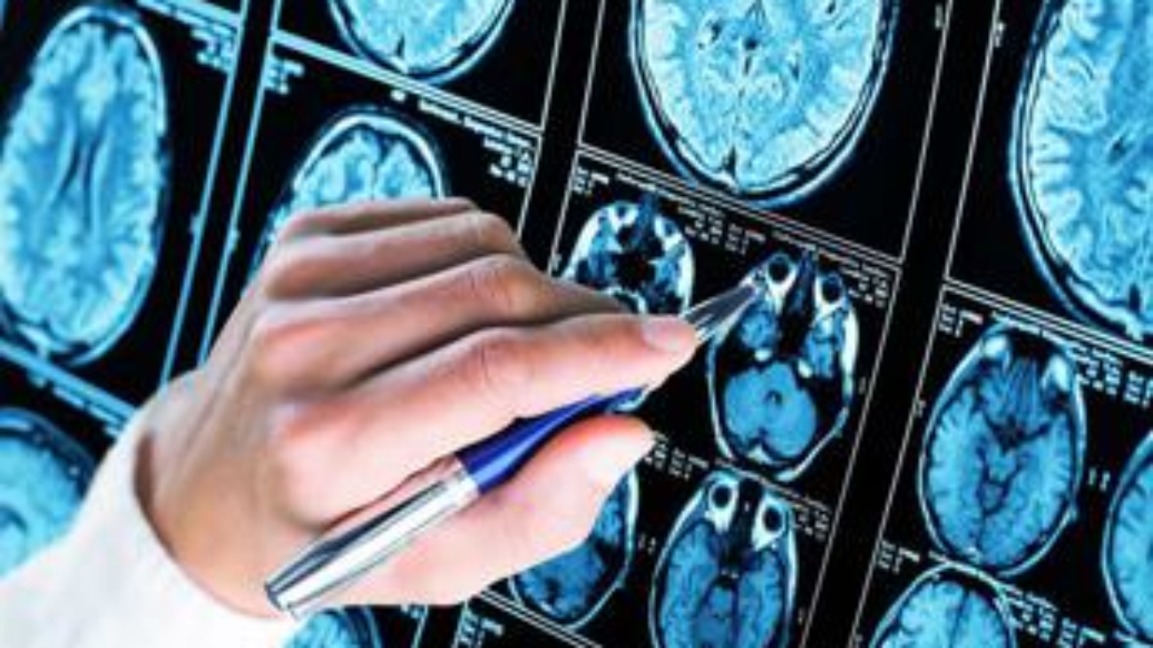 Nuova frontiera anti-Alzheimer: così si combattono le proteine tossiche