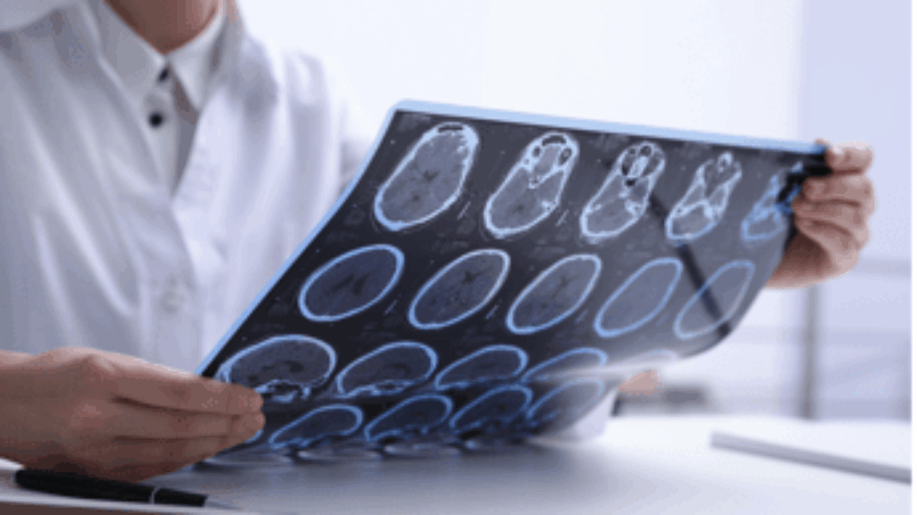 Sclerosi multipla, neurologi: "Con nuovi strumenti la diagnosi sempre più precoce"