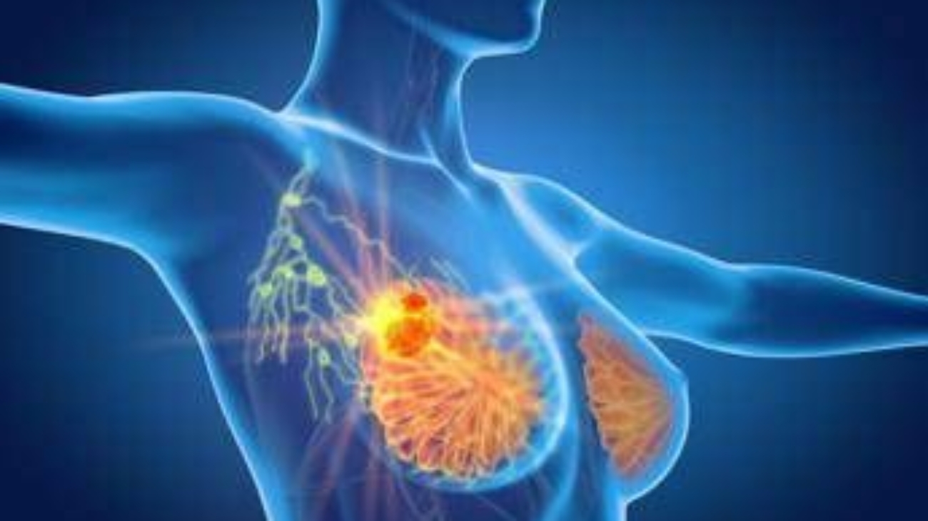 Per cancro seno la cura che arriva dal gelo, Ieo: "Verso un futuro no bisturi"