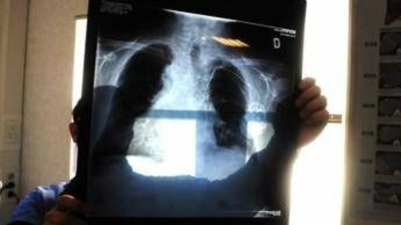 Tumori, in carcinoma polmonare risultati positivi da combinazione in prima linea