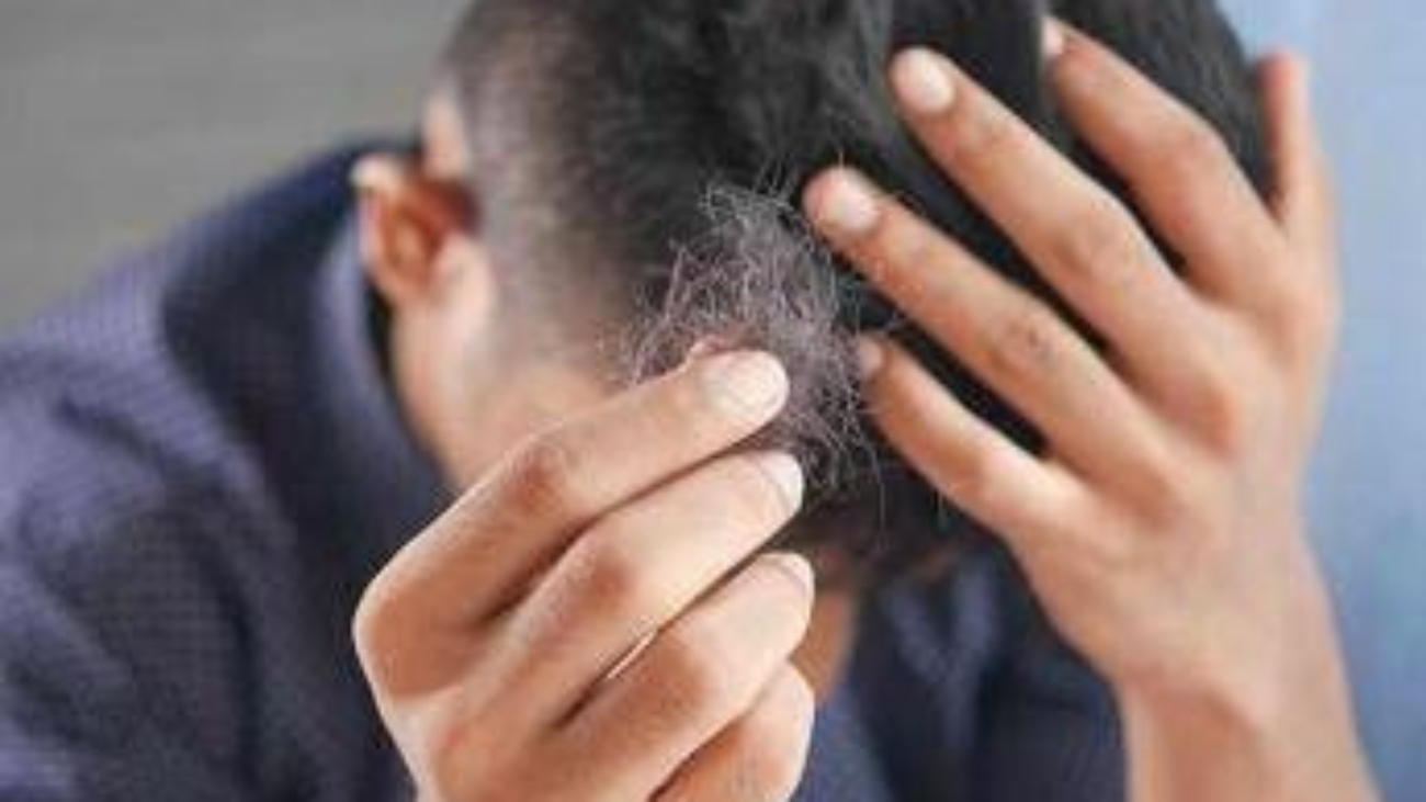 Il dermatologo: "Con alopecia areata disagi e costi alti, svecchiare linee guida"