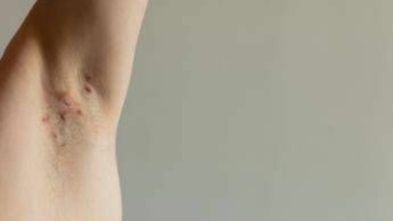 Idrosadenite suppurativa, appello esperti 'sia inserita nel Piano delle cronicità'