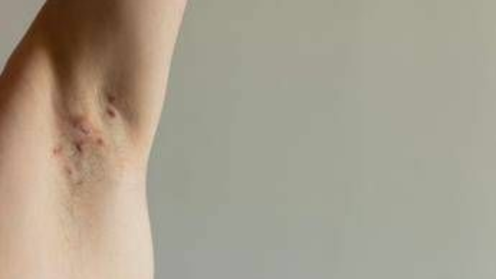 Idrosadenite suppurativa, appello esperti 'sia inserita nel Piano delle cronicità'