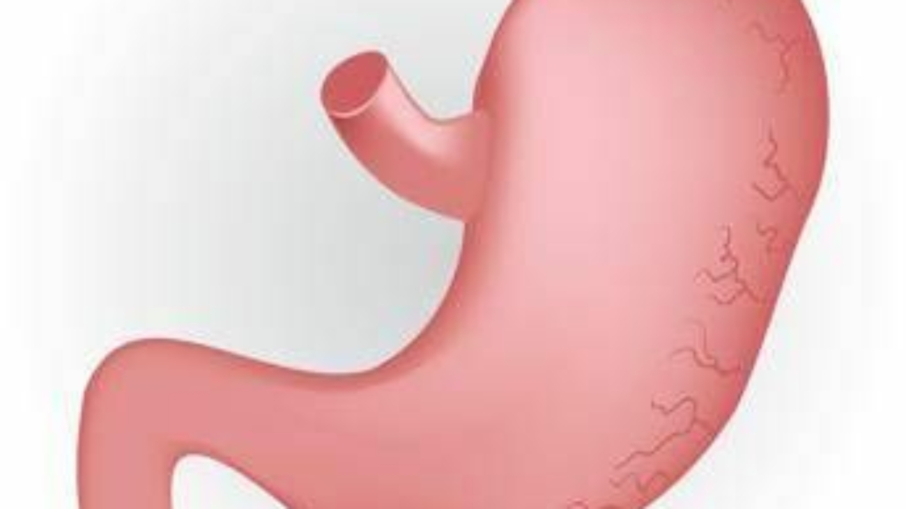 Caldo peggiora sintomi del reflusso, in casi gravi "chirurgia opzione risolutiva"