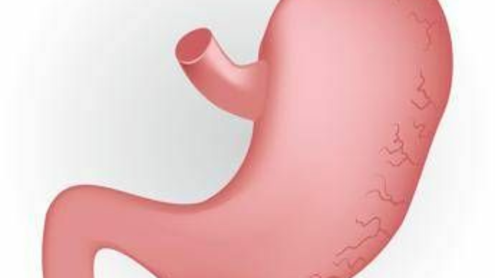 Caldo peggiora sintomi del reflusso, in casi gravi "chirurgia opzione risolutiva"