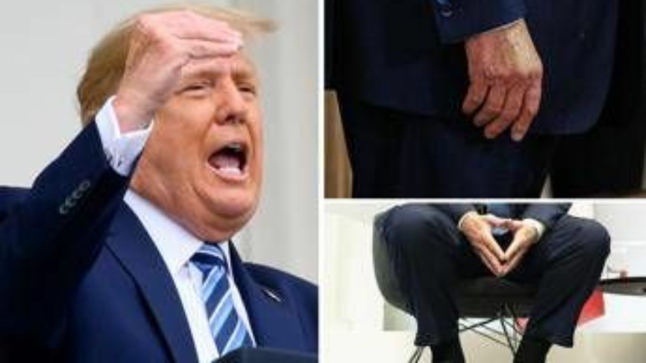 Trump e le gambe gonfie, cos'è l'insufficienza venosa cronica