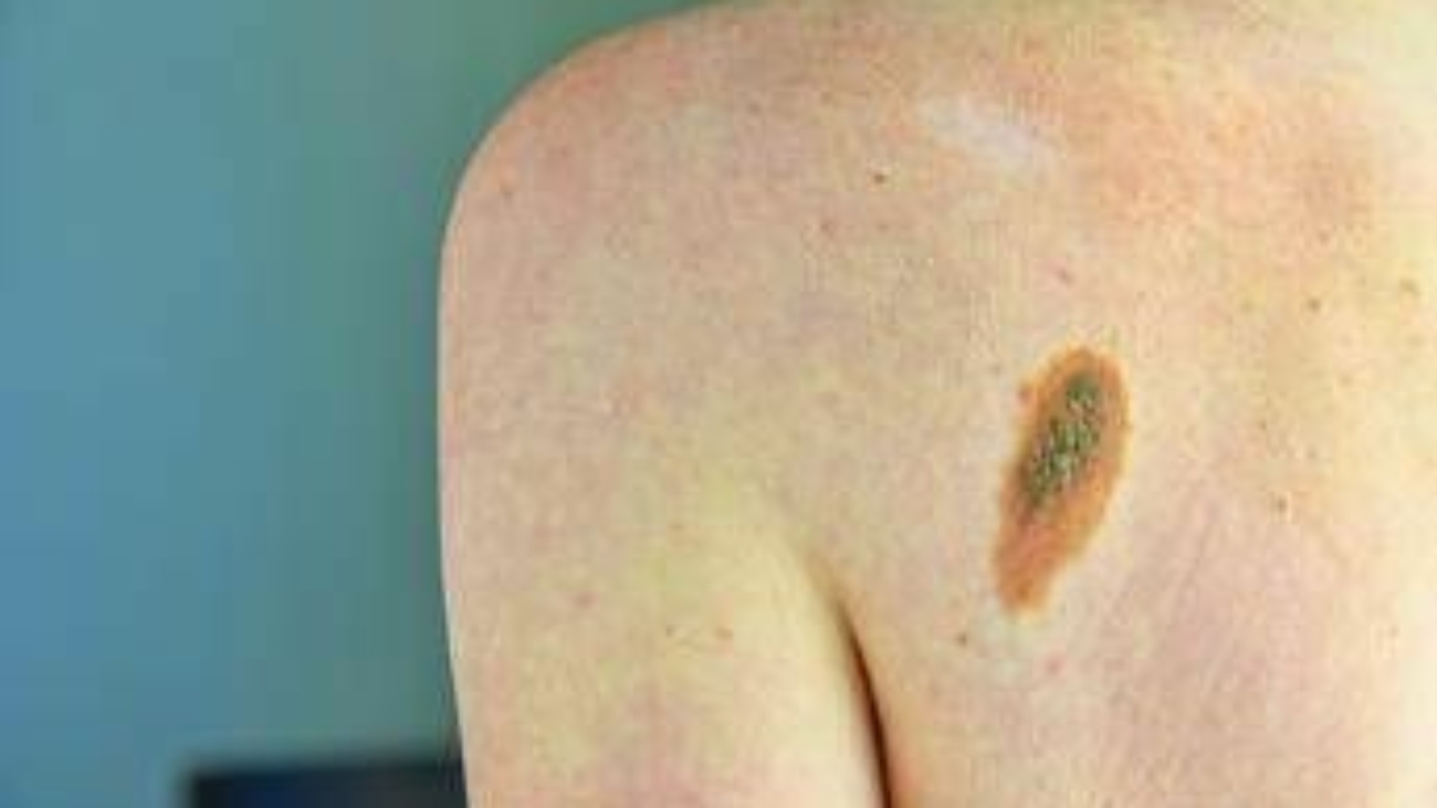 Prevenzione melanoma, Sidemast pronta a collaborare per percorsi chiari
