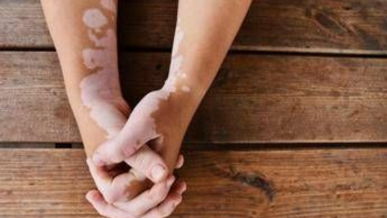 Estate, vitiligine e sole: le regole per una abbronzatura sicura