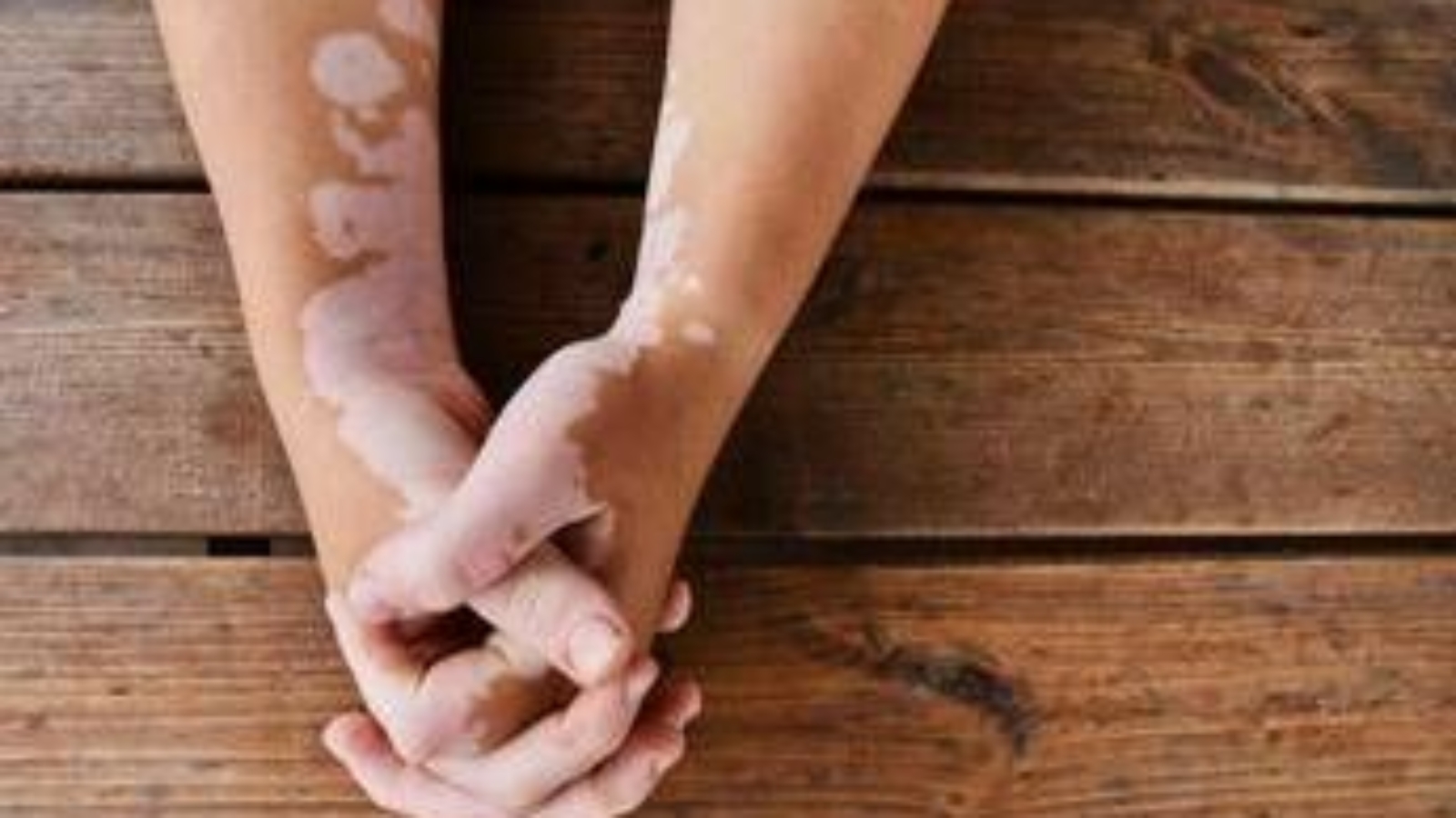 Estate, vitiligine e sole: le regole per una abbronzatura sicura