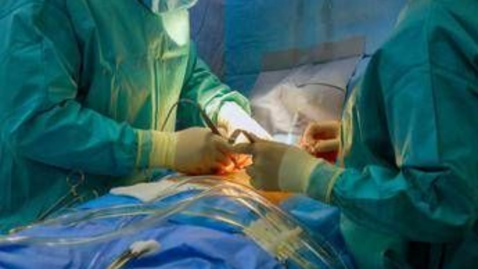 Chirurgia, a Padova innovativo intervento per cura epilessia farmaco resistente