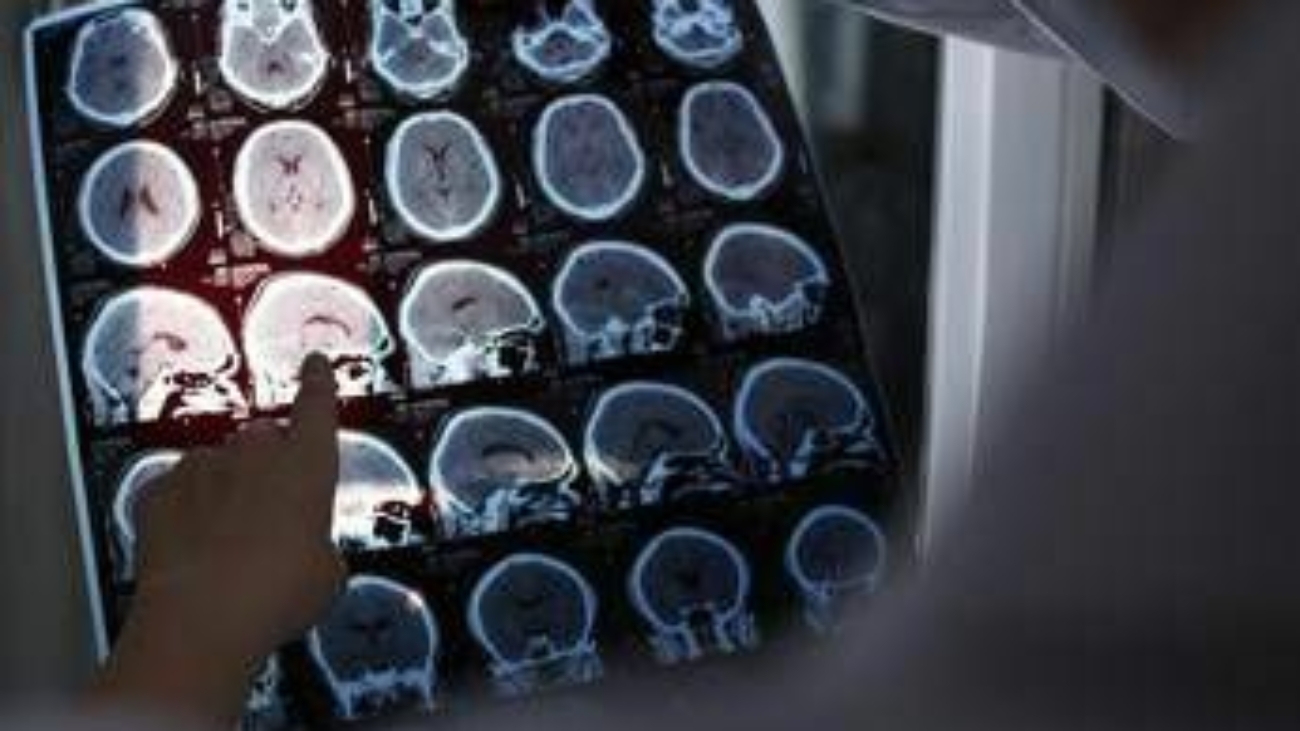 Nuove molecole e bersagli, così si evolve la terapia contro l'Alzheimer: il punto