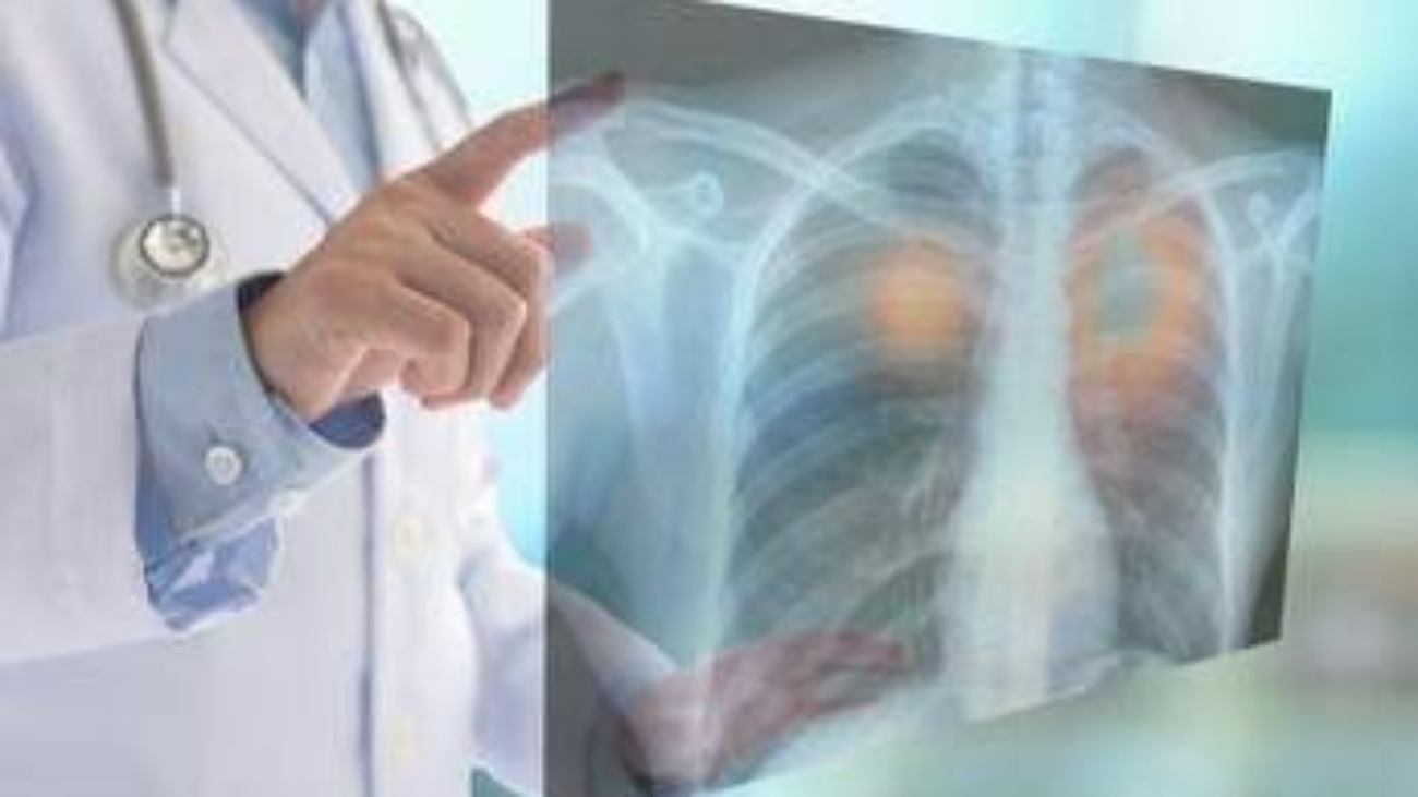 Tumori, nel 2050 i morti cancro supereranno i 18 milioni (+75%): lo studio su Lancet