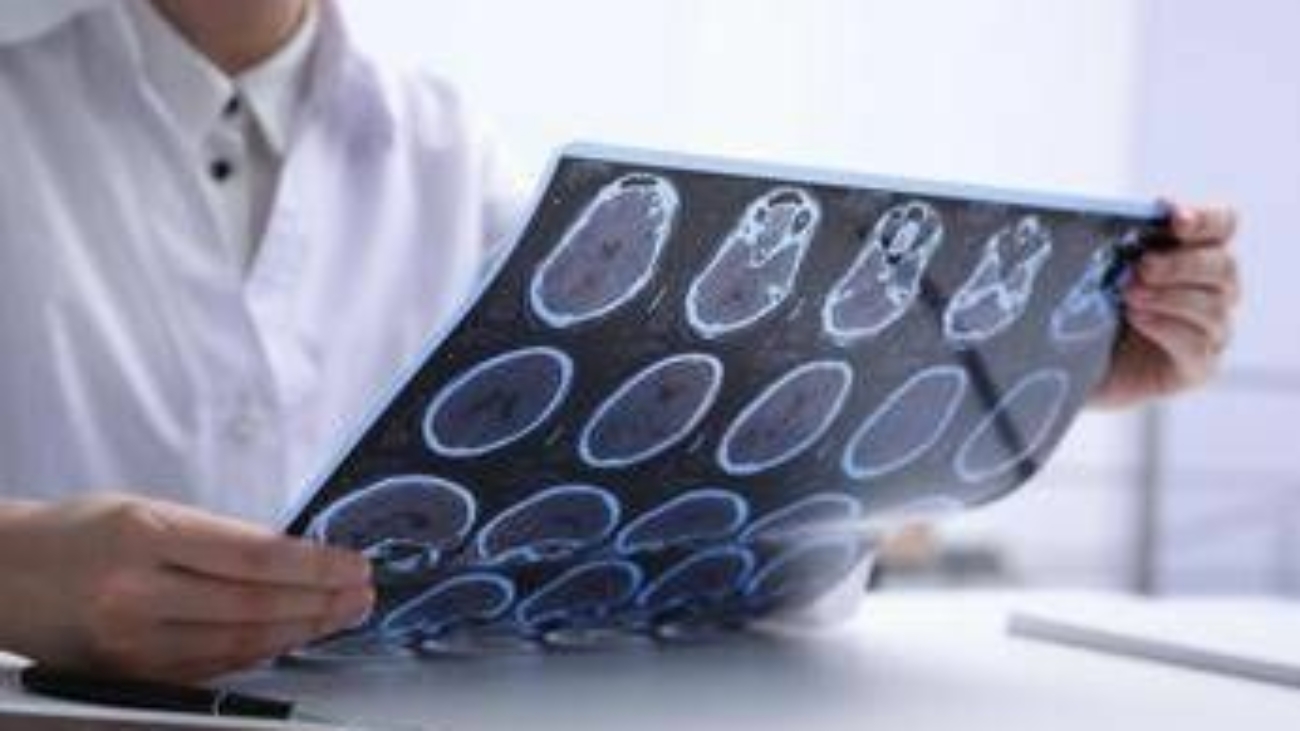 Giornata Sla, neurologi: "Non resti confinata alla sperimentazione"