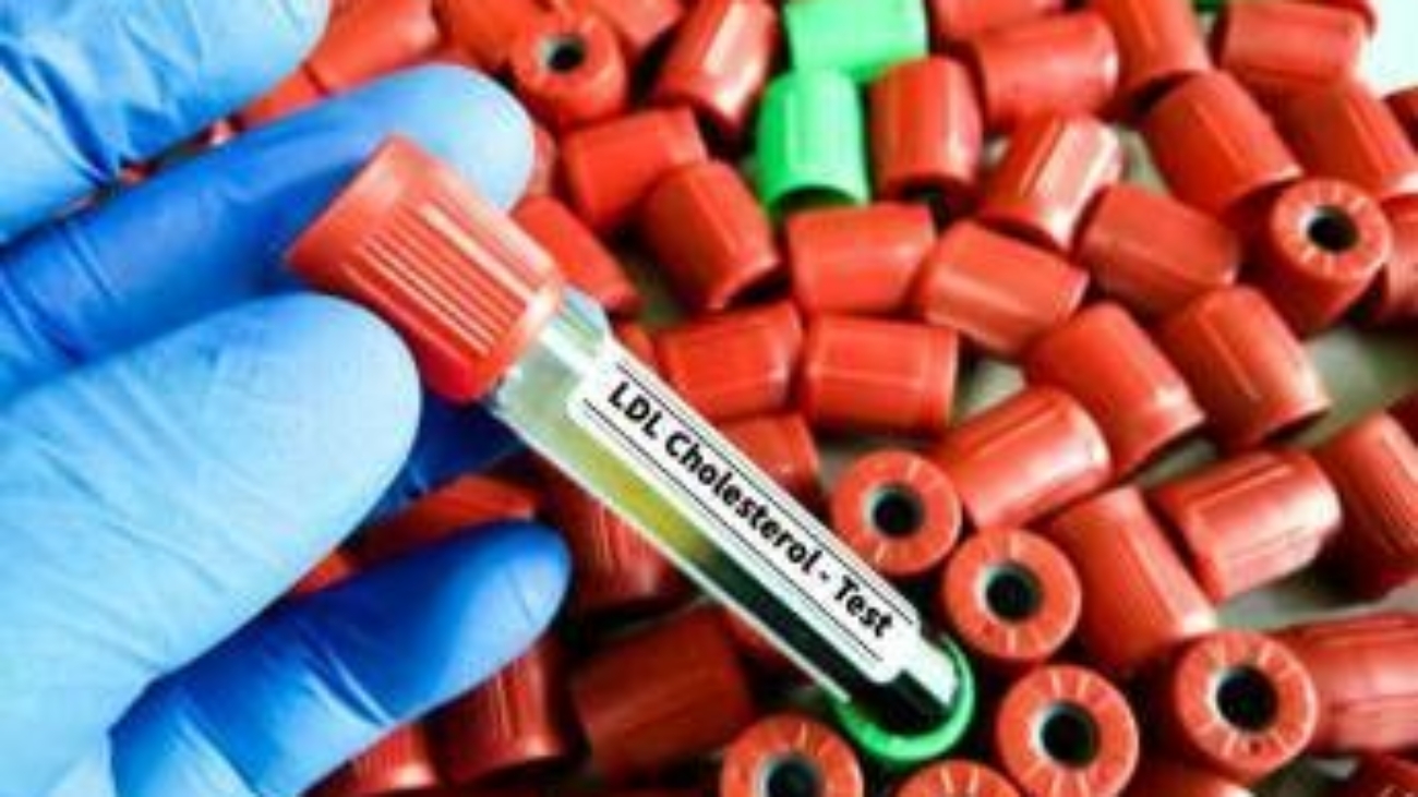 Colesterolo Ldl, per abbassalo in sviluppo nuova terapia con tripla combinazione 