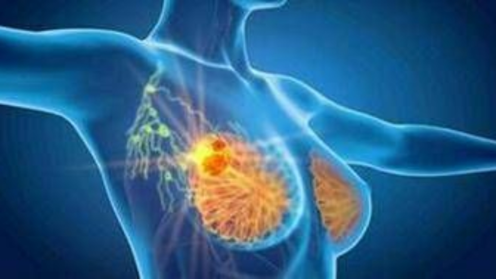Cancro seno iniziale Her2+, con anticorpo farmaco-coniugato -53% recidiva