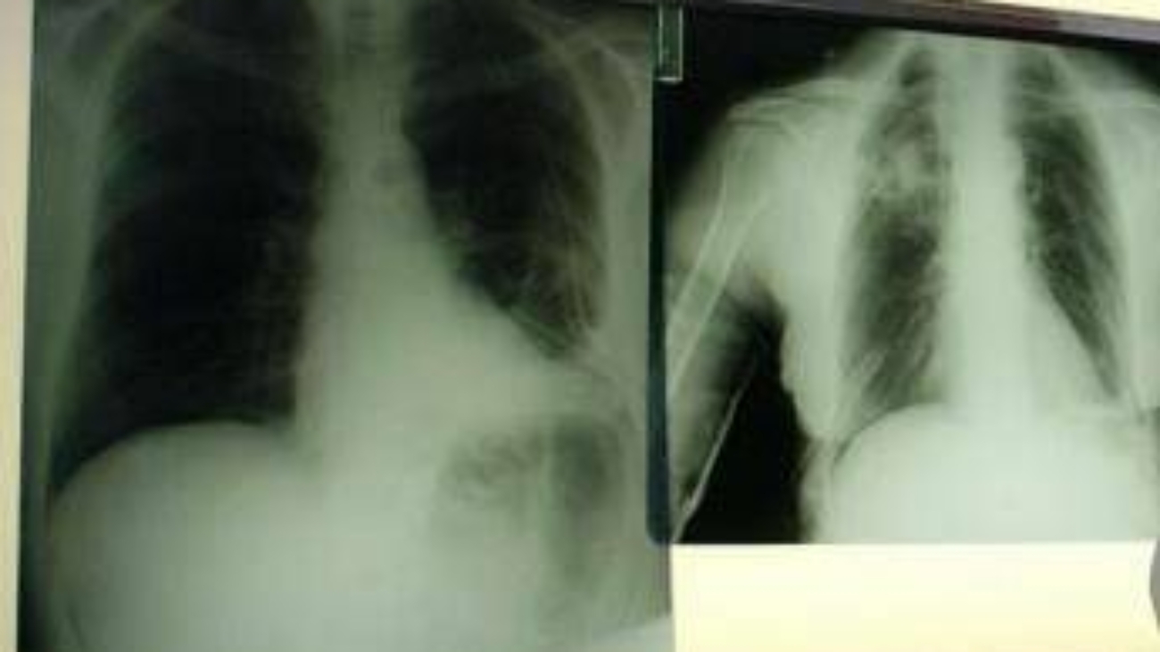 Salute, esperti: "Virus sinciziale sottovalutato nonostante oltre 50mila ricoveri l'anno"