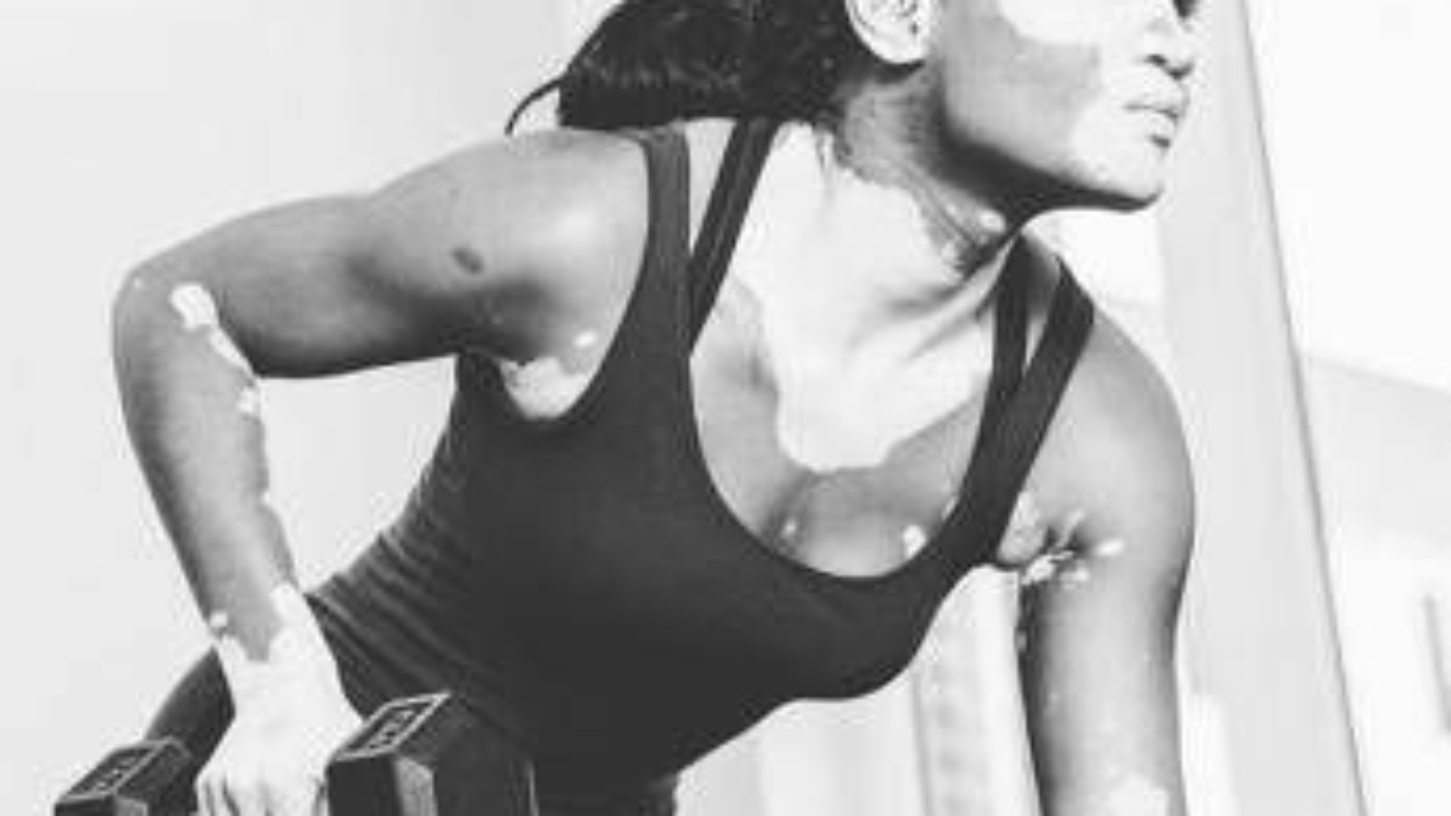 E' la Vitiligine week, "così la terapia della luce aiuta il farmaco"