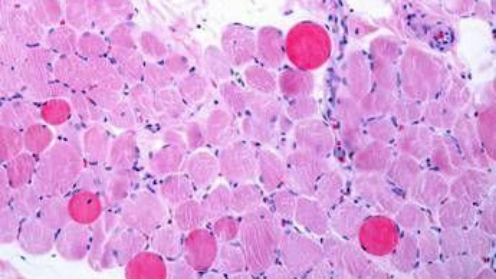 Malattie rare, risultati positivi a 5 anni per vamorolone in distrofia Duchenne