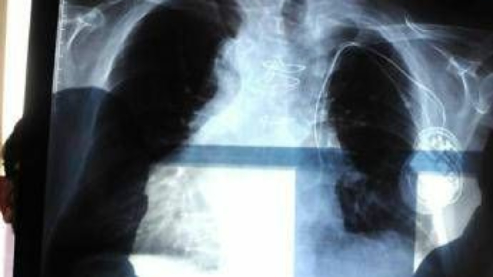 Polmonite, ogni anno in Italia 150mila ricoveri e 9mila morti: i sintomi