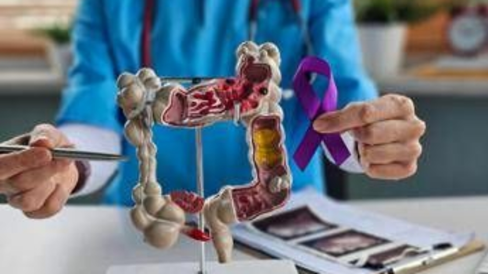 Tumori del colon retto, Int Milano in progetto Ue che punta a prevedere efficacia immunoterapia