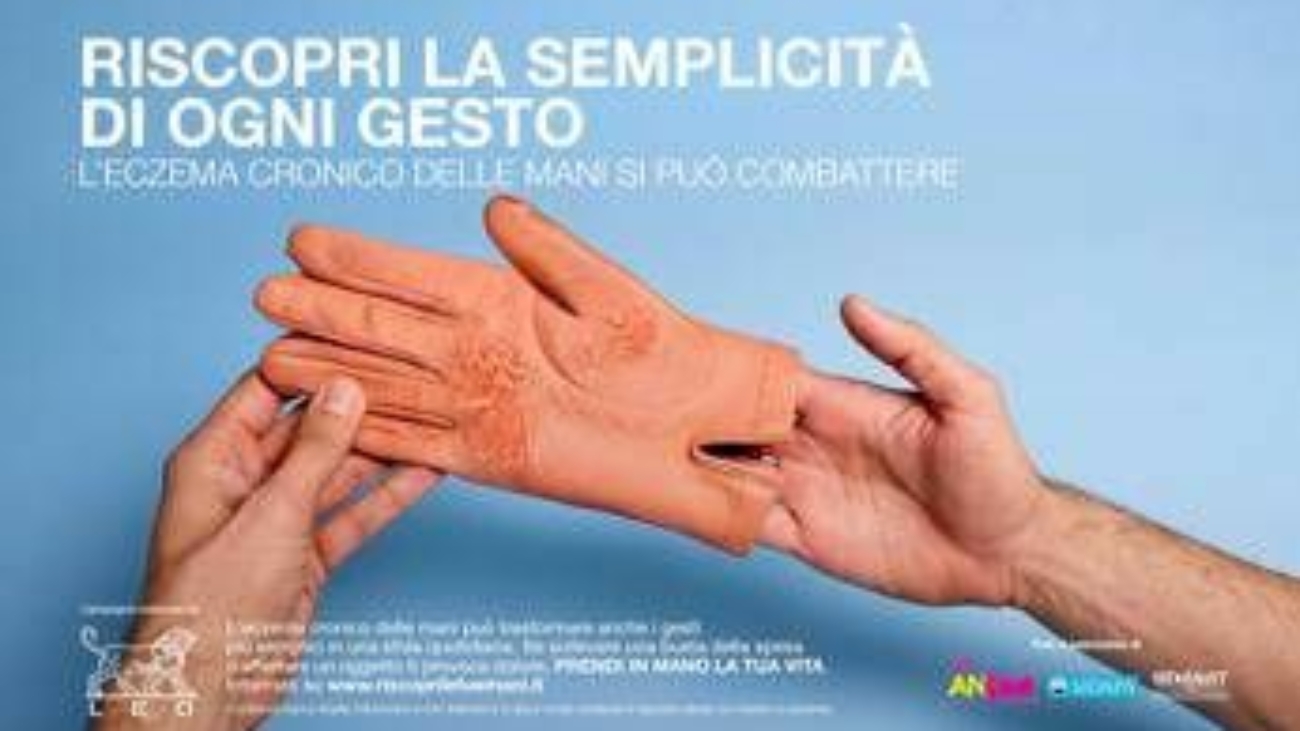 Mani che bruciano e fanno male, al via campagna su eczema cronico