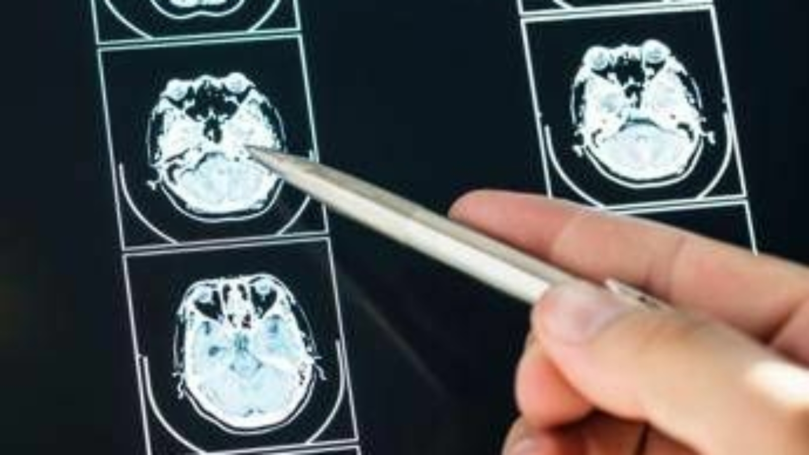 Ecco come il Long Covid cambia il cervello con meccanismi tipici dell'Alzheimer
