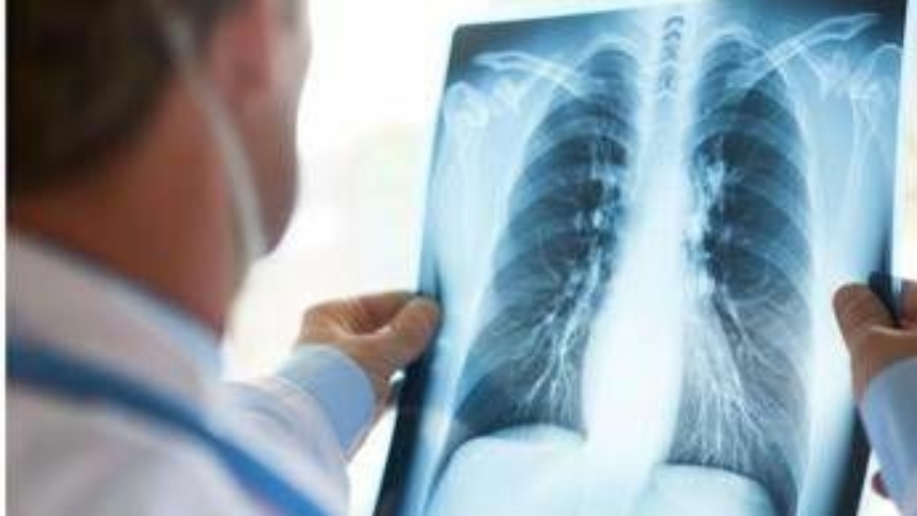 Tumore al polmone a piccole cellule in stadio esteso, ok Aifa a primo anti Pd-1 in prima linea