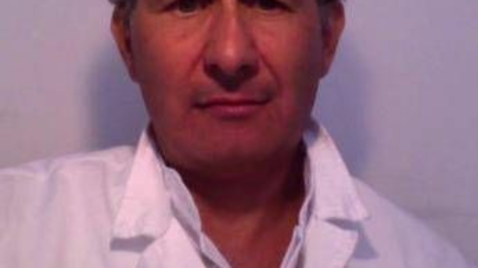 'Faccia a luna piena' e pelle sottile, è la sindrome di Cushing. Cos'è e come si cura