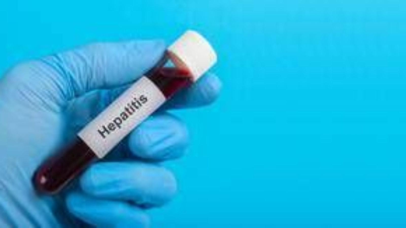 Igienista Triassi: "Focoloaio epatite A punta iceberg"