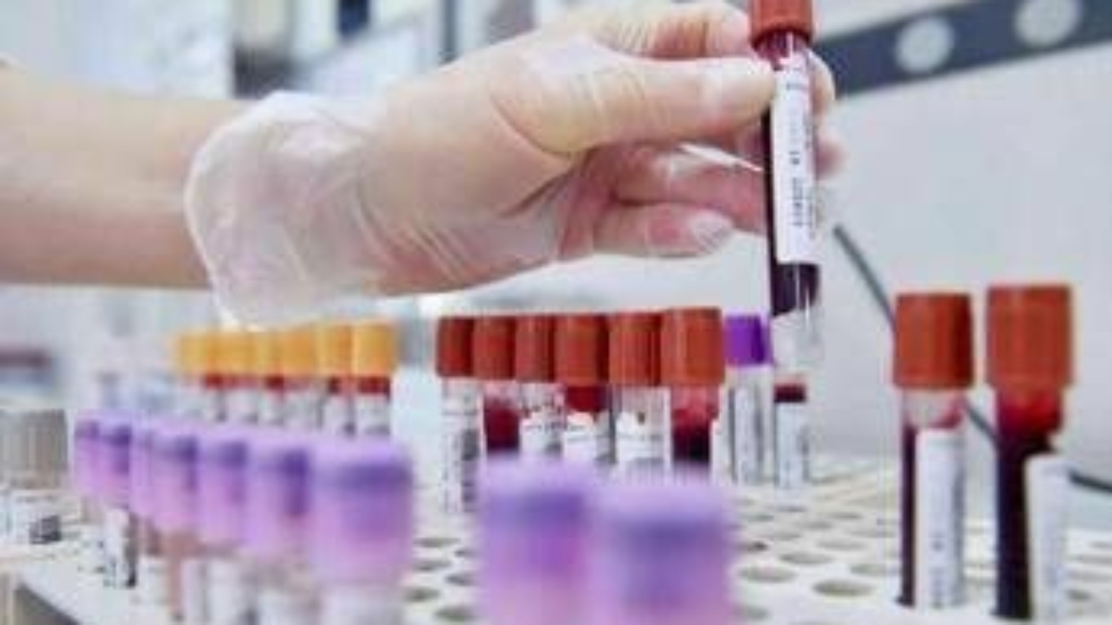 Allarme oncologi: "- 50% trial in Europa in 10 anni mentre Cina accelera"