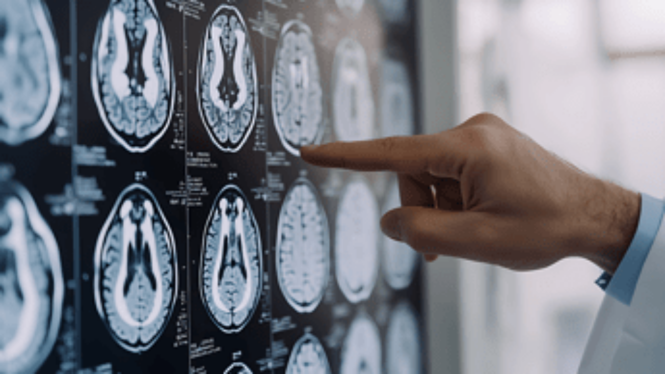 Tumori: glioma, Fda riconosce come farmaco orfano l'isotopo rame-64 sviluppato nelle Marche