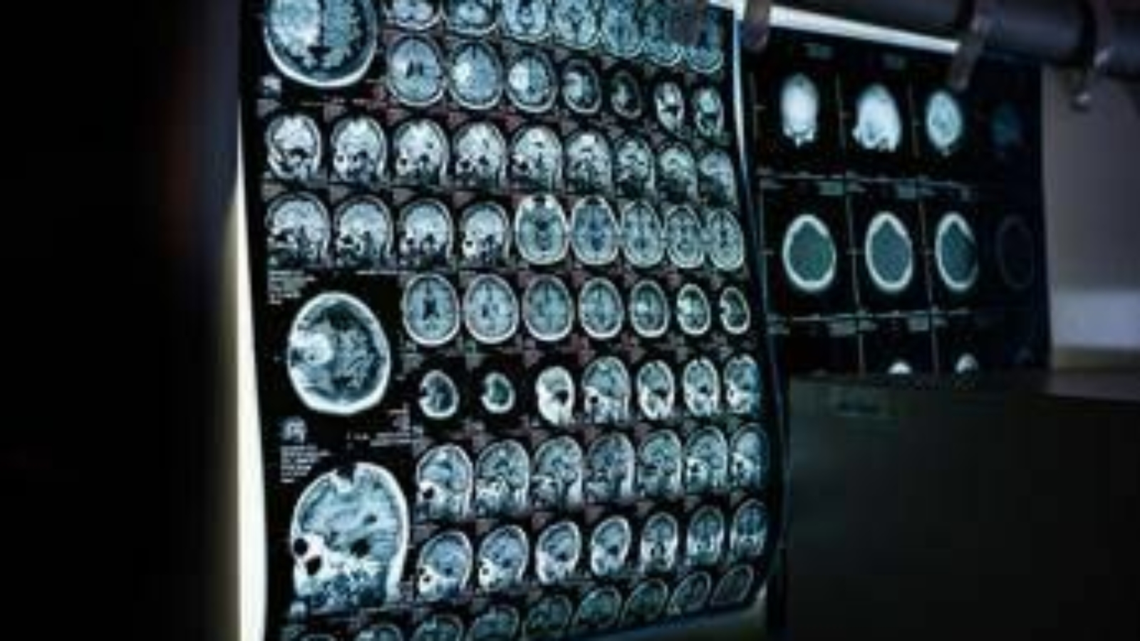 Uno spray nasale ferma l'invecchiamento del cervello, lo studio