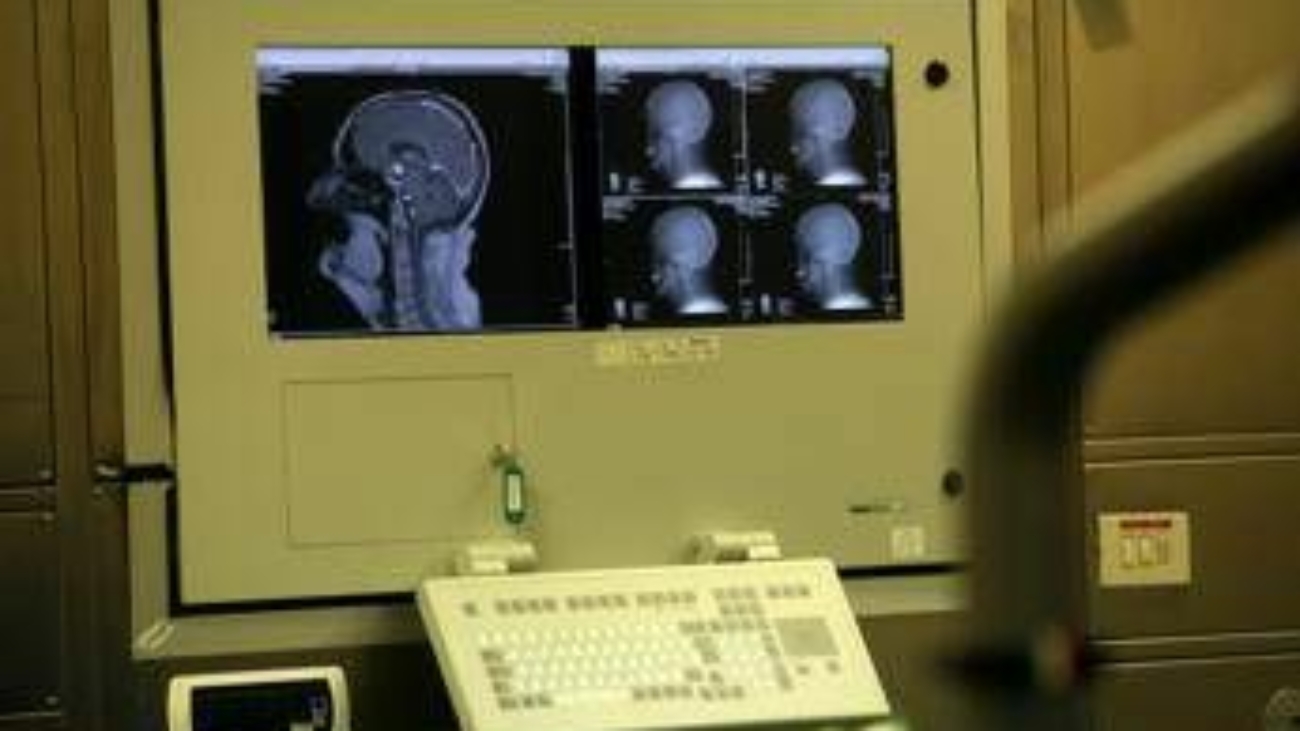 Sogni agitati sintomo Parkinson? Medici anti-bufale 'può accadere, si fa polisonnografia'