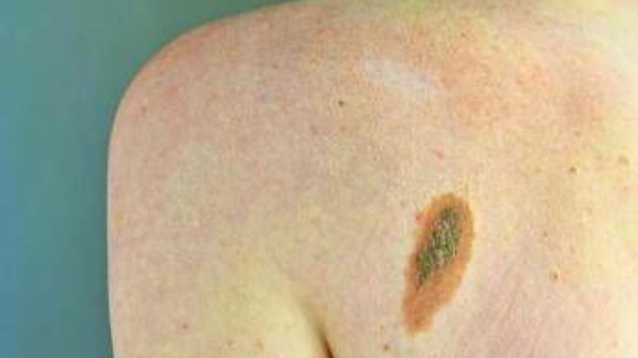 Ogni anno in Italia 2.600 casi ereditari di melanoma, Imi:"Prevenzione con test genetici e controlli"