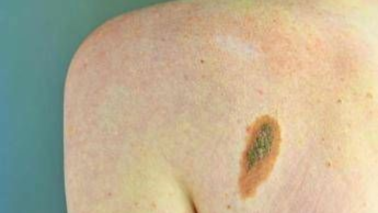 Ogni anno in Italia 2.600 casi ereditari di melanoma, Imi:"Prevenzione con test genetici e controlli"