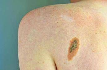 Ogni anno in Italia 2.600 casi ereditari di melanoma, Imi:"Prevenzione con test genetici e controlli"
