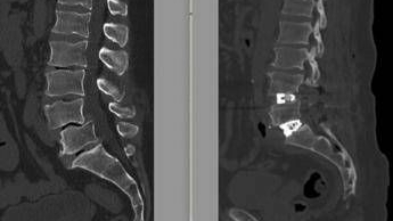 Chirurgia vertebrale complessa, al Tiberia Hospital di Roma intervento con tecnica Alif