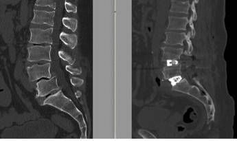 Chirurgia vertebrale complessa, al Tiberia Hospital di Roma intervento con tecnica Alif