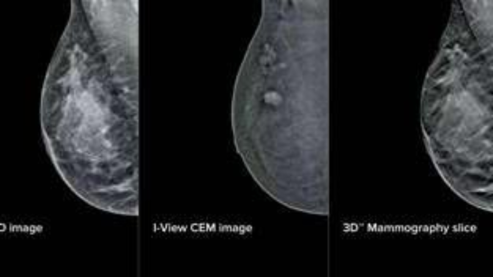 Mammografia 'intelligente' al San Camillo di Roma, aiuterà gli specialisti nelle diagnosi